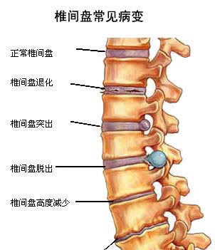 椎间盘向后方突出就会压迫到脊椎神经,在腰椎处则称为腰椎间盘突出.